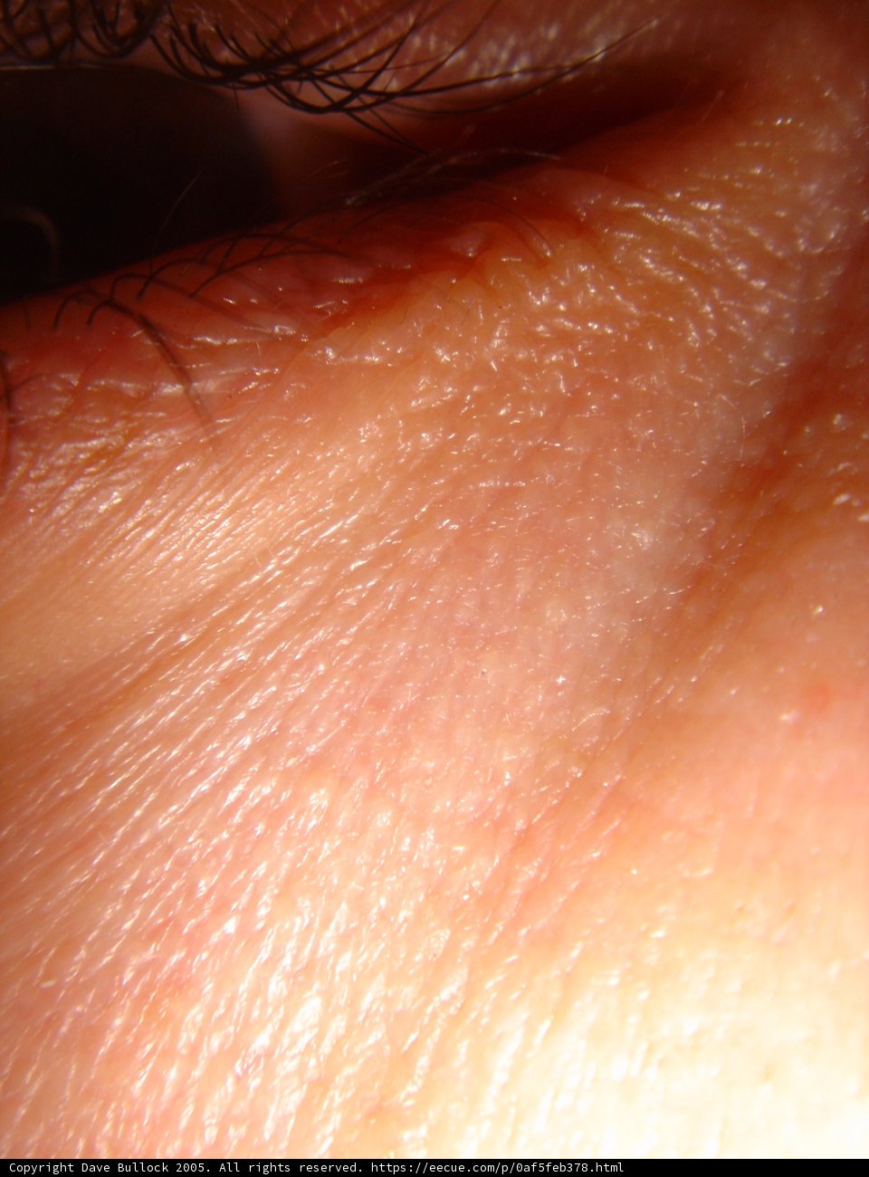 A Close-Up of a Person's Eye with a Large White Spot