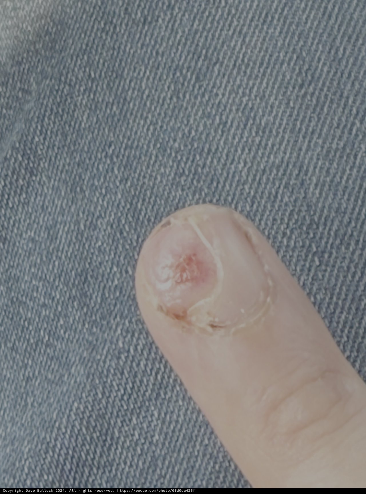 Close-up of Finger with Wart or Growth
