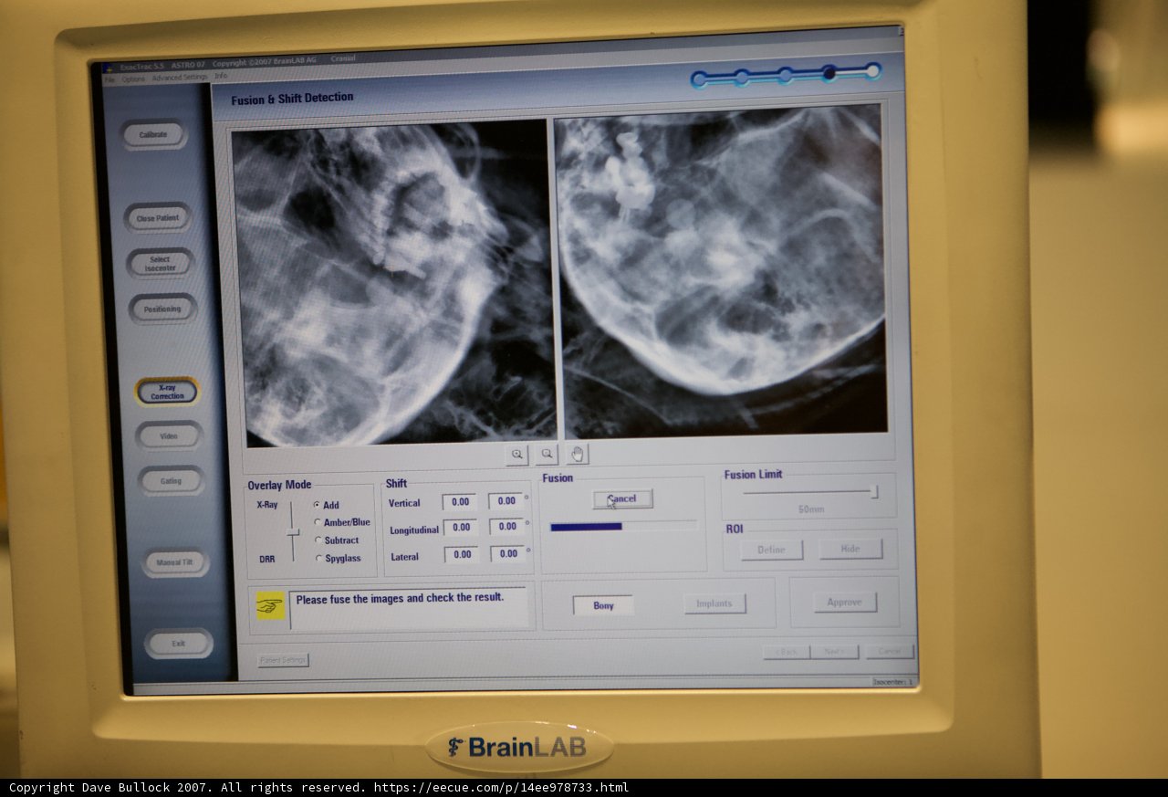 CT Scan of Woman's Chest