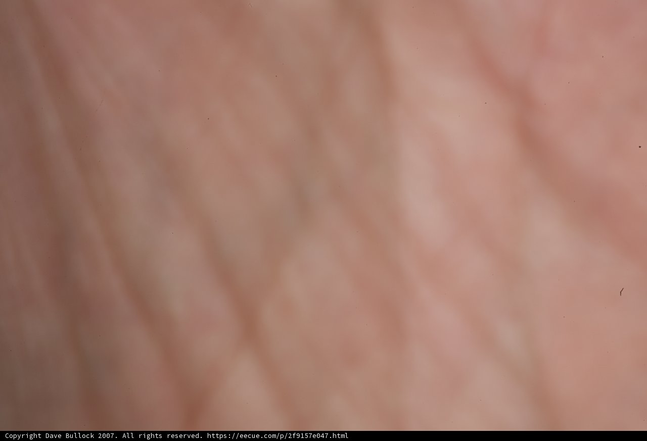 Mysterious Black Dot on Skin