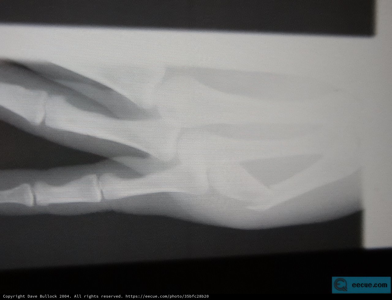 Fractured Hand