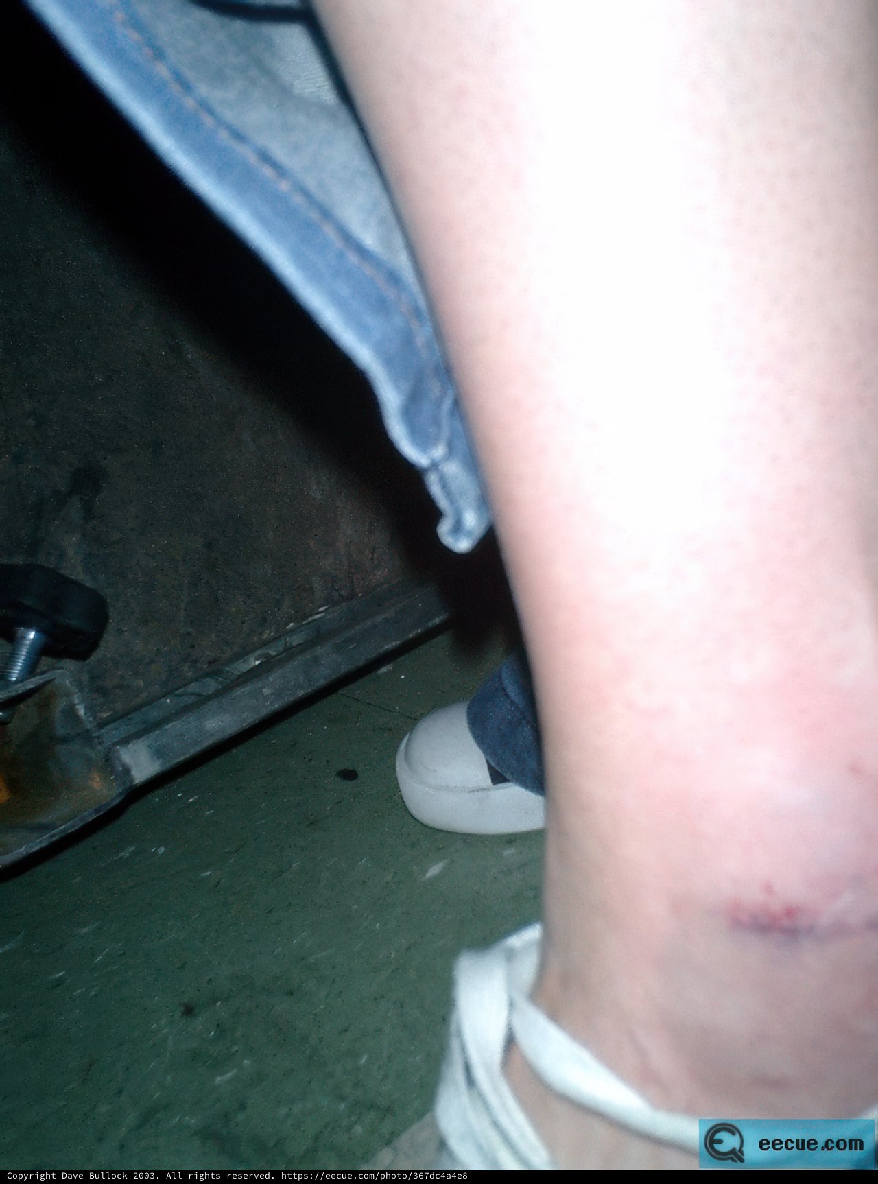 Injury on the Ankle