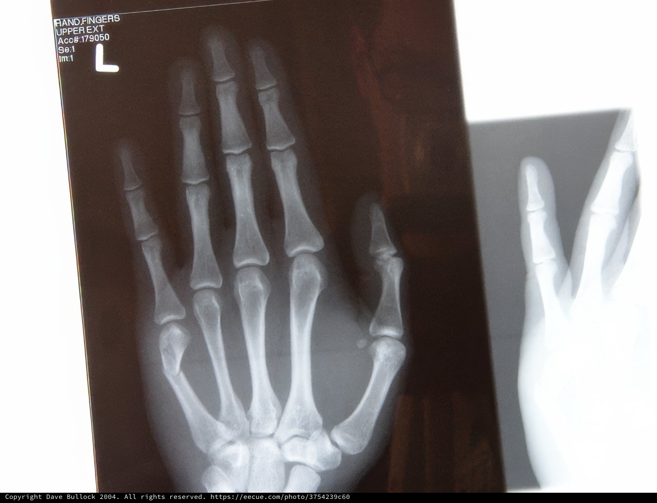 A broken hand, revealed by X-ray