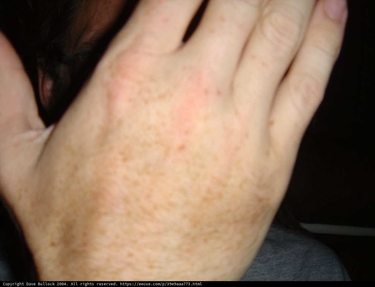 Freckled Fingers