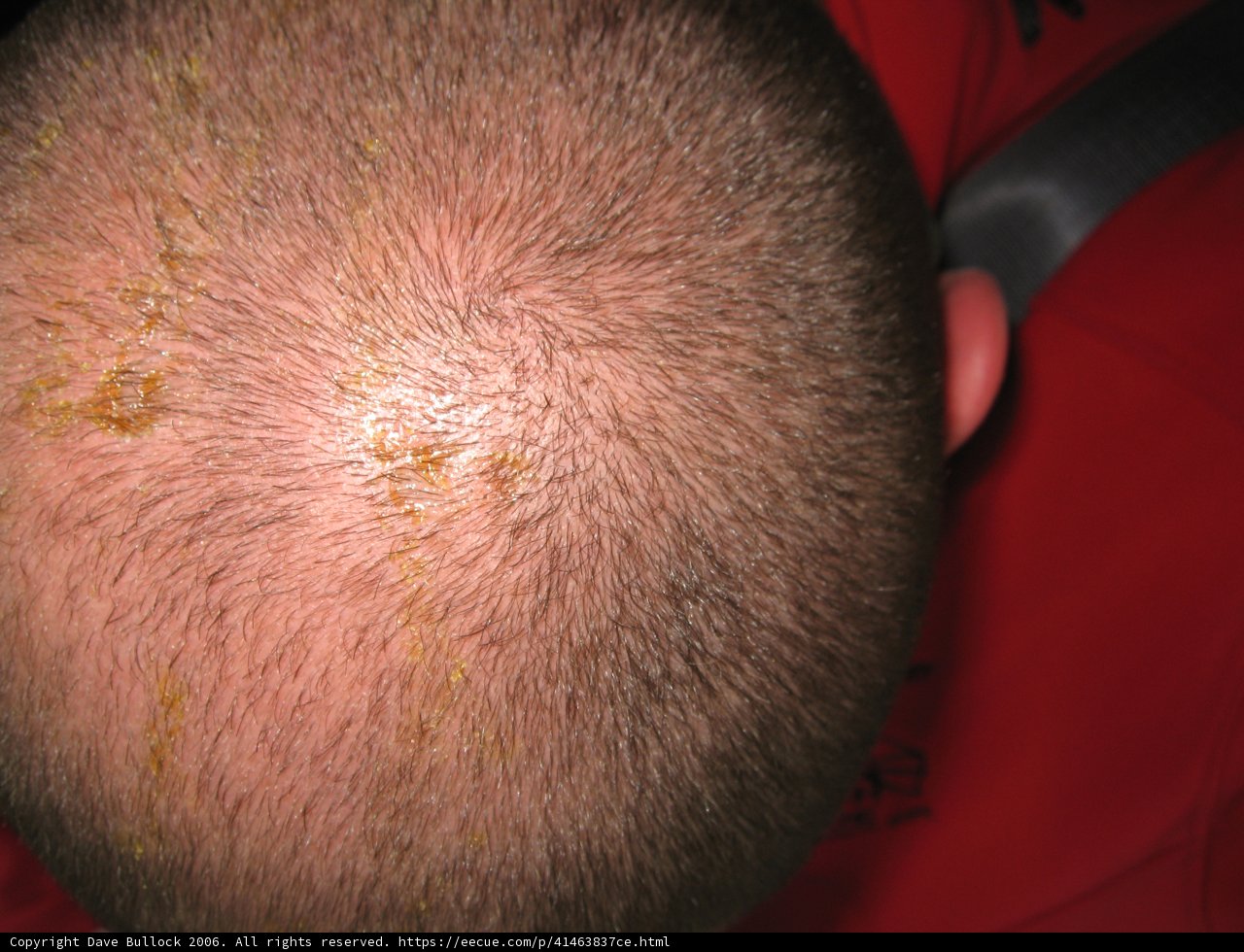 Yellow Patched Bald Head