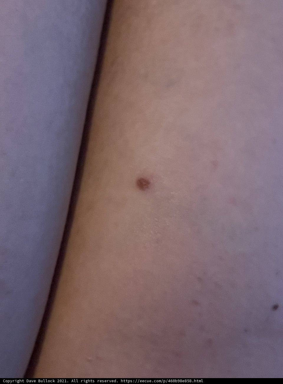 The Mole on My Arm