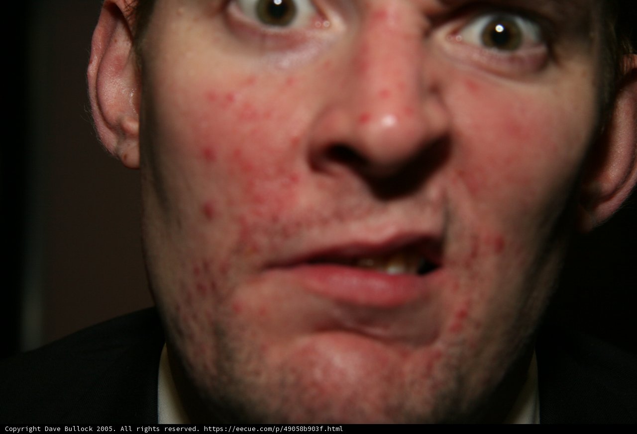 Flushed and Freckled