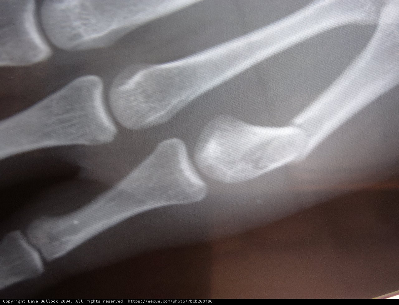 Broken Hand Bone