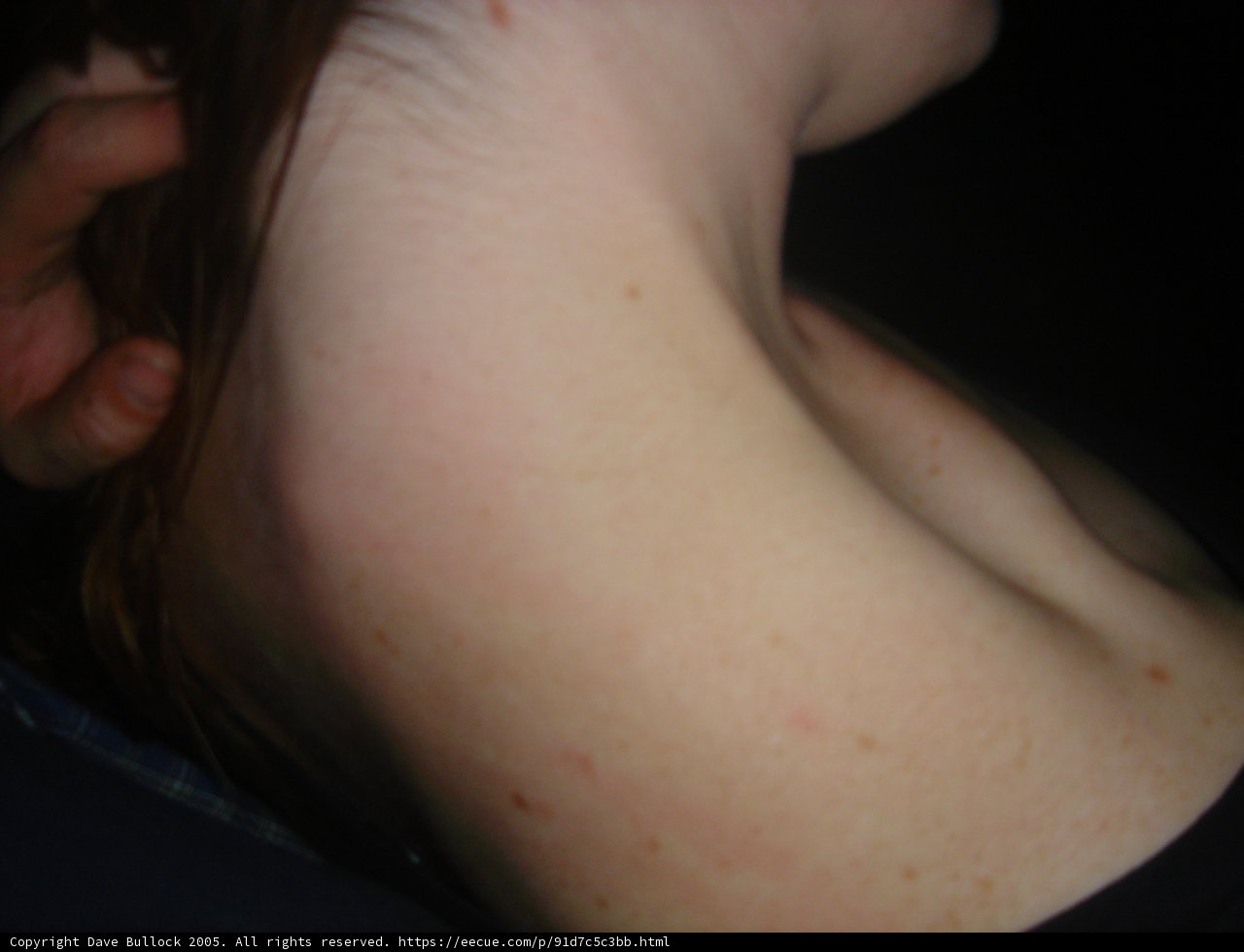 Red Spot on Woman's Neck