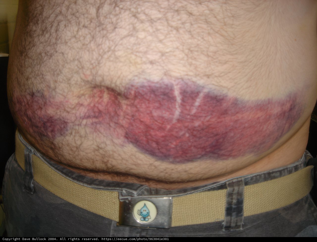 Bruised and Tattooed