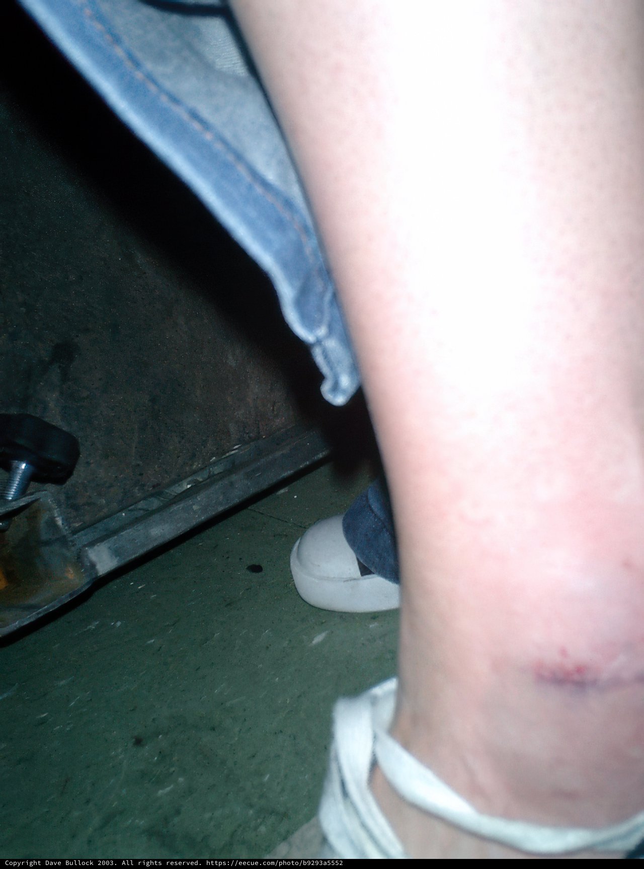 Minor Injury