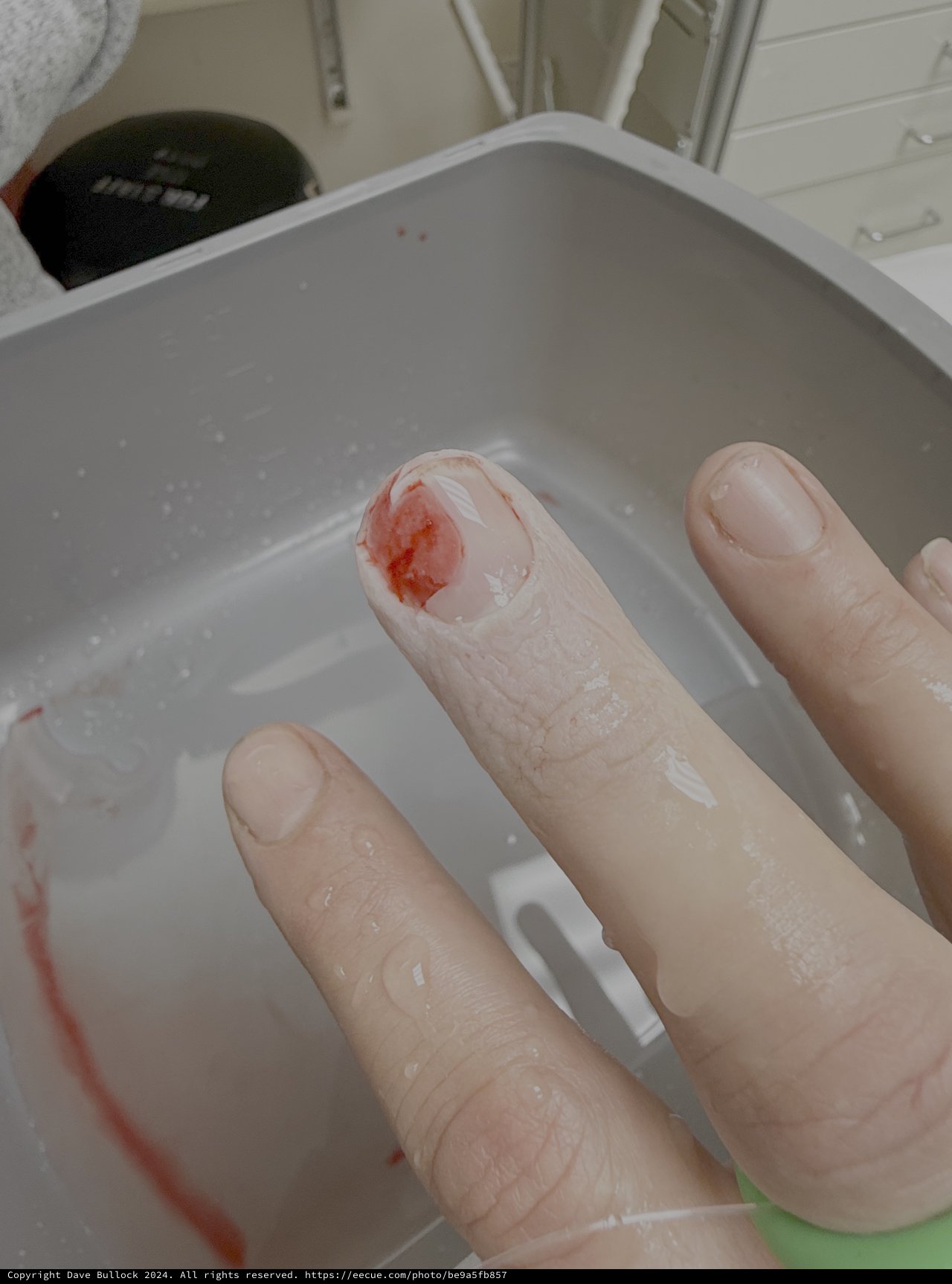 Injured Finger Being Cleaned in Sink