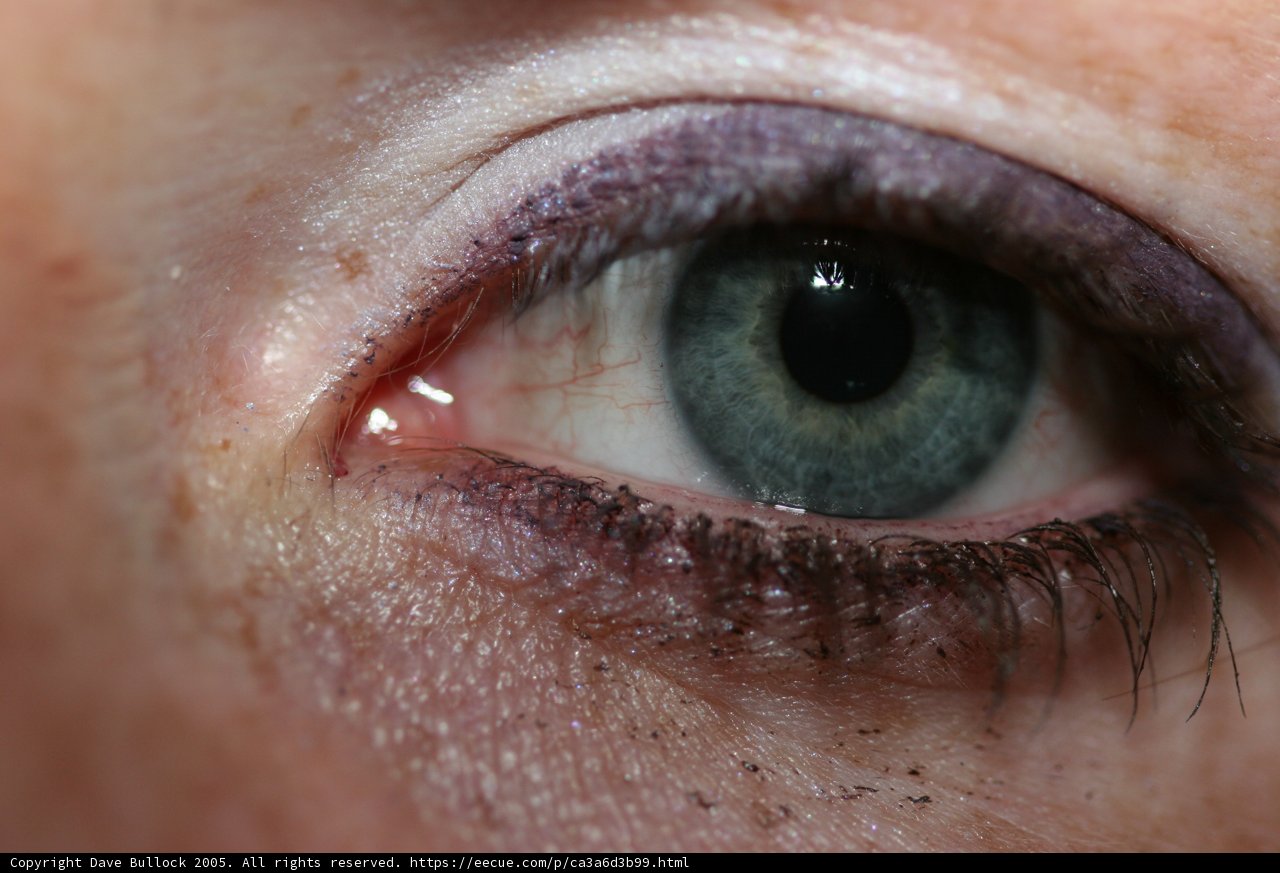 Tearful Eye