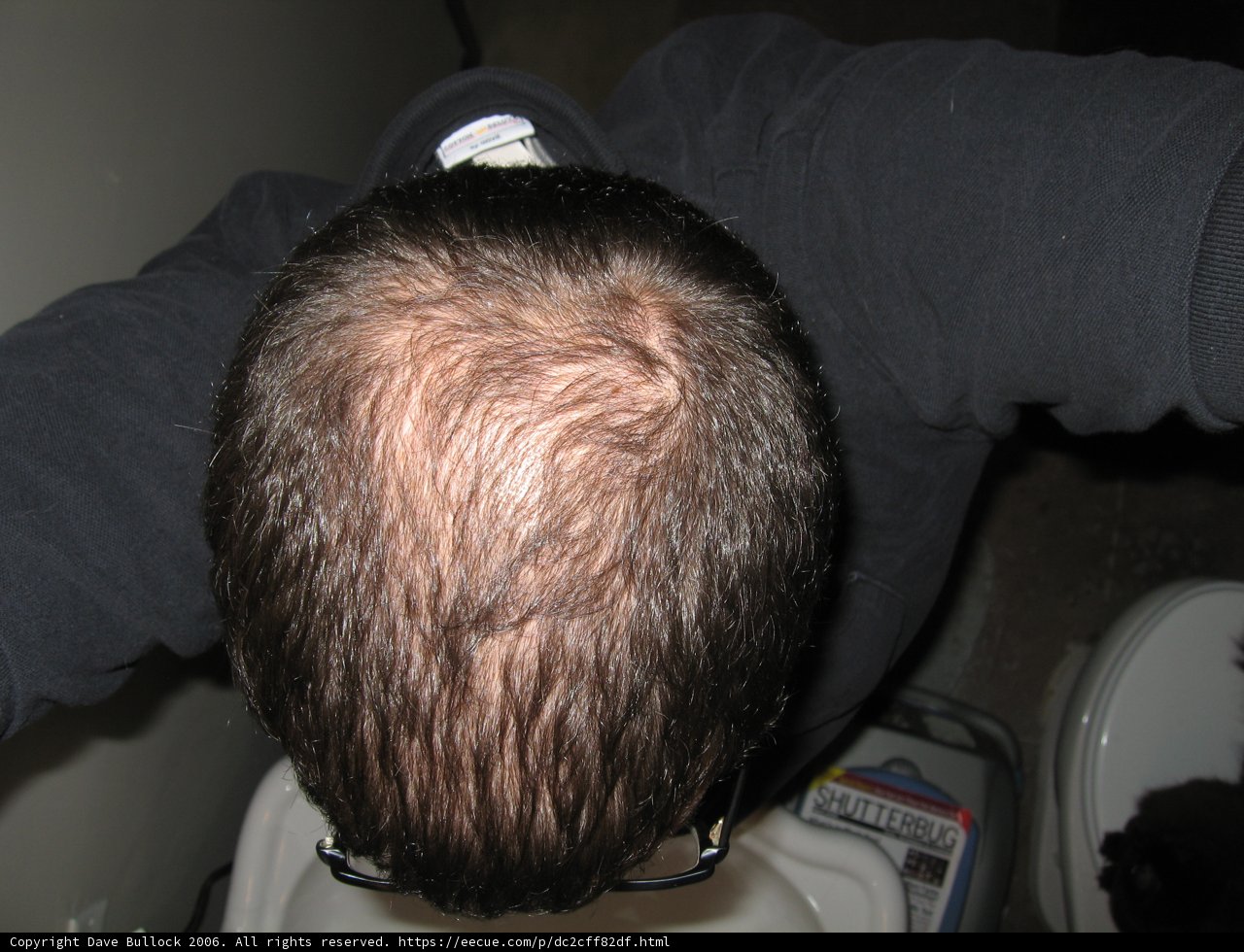 Receding Hairline