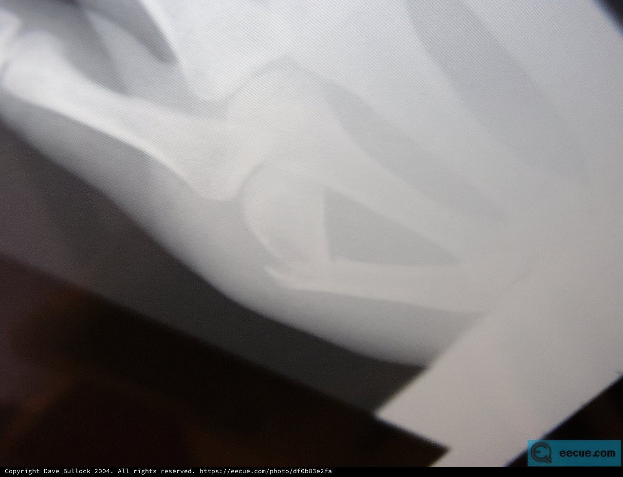 X-Ray of Bone