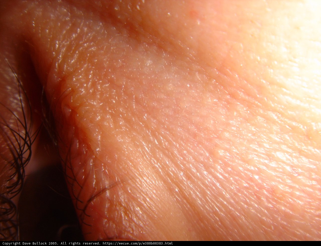 Mole on the Neck