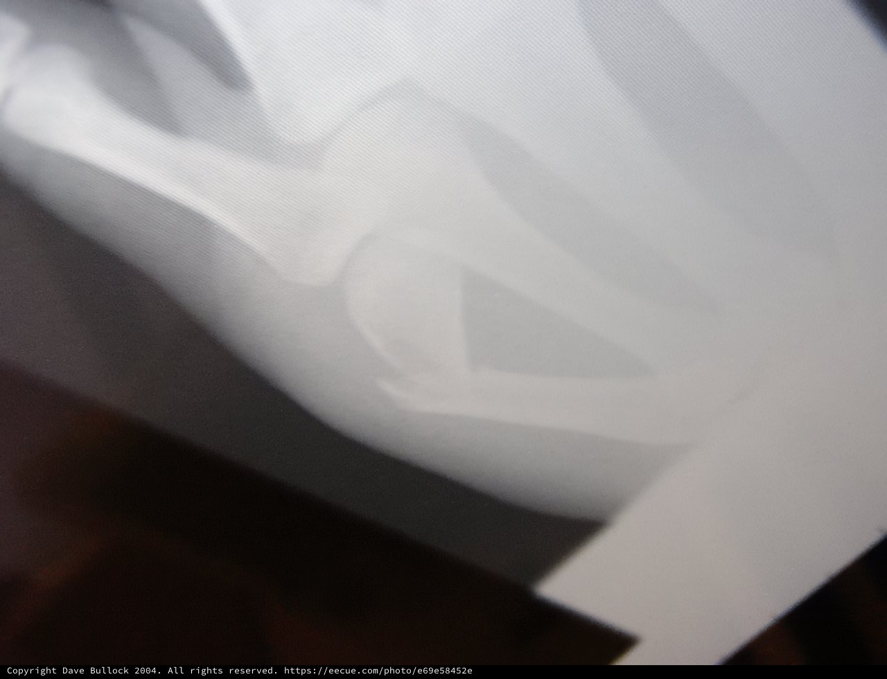 Broken Hand with Bone Sticking Out