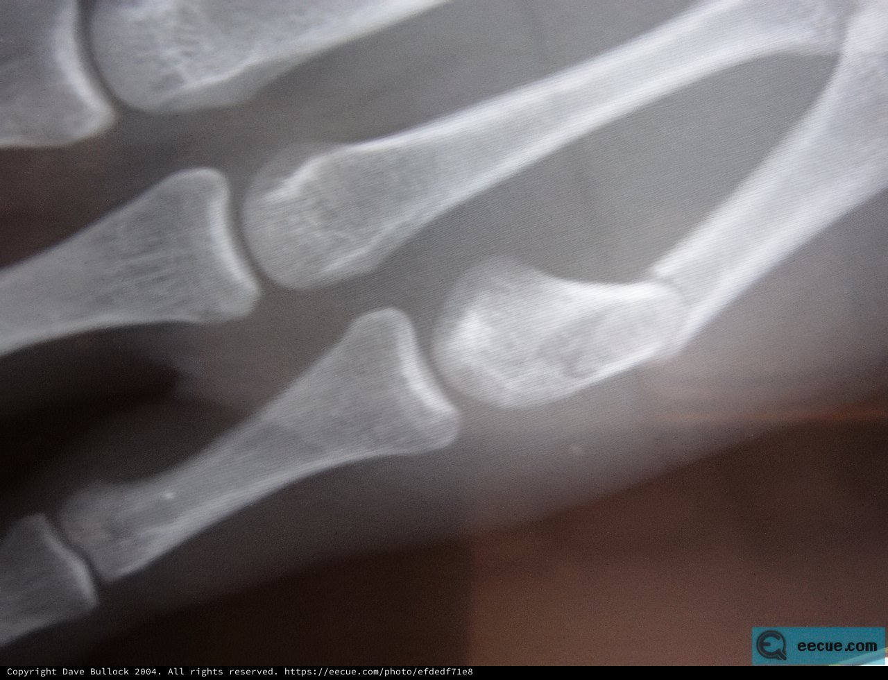 Fractured Bone in Close-Up