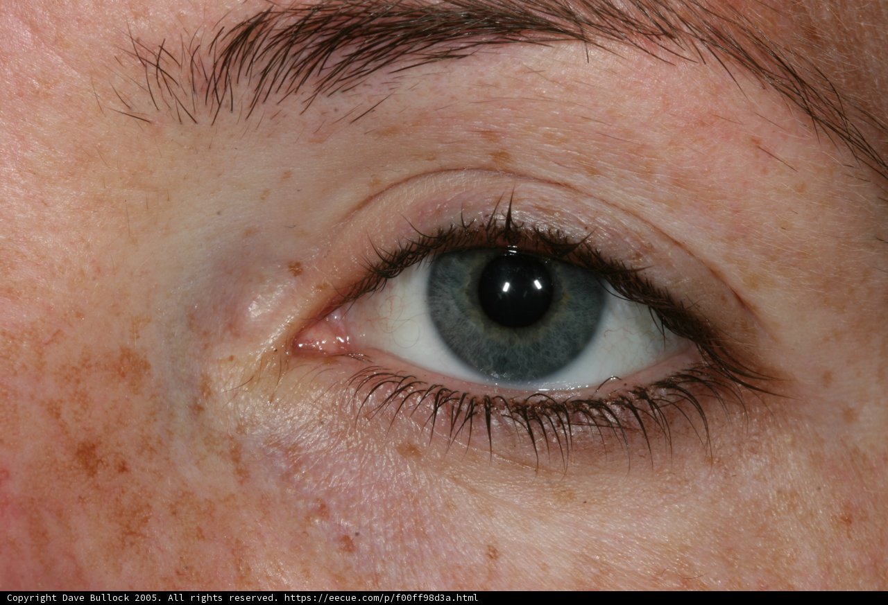 Freckled Eye