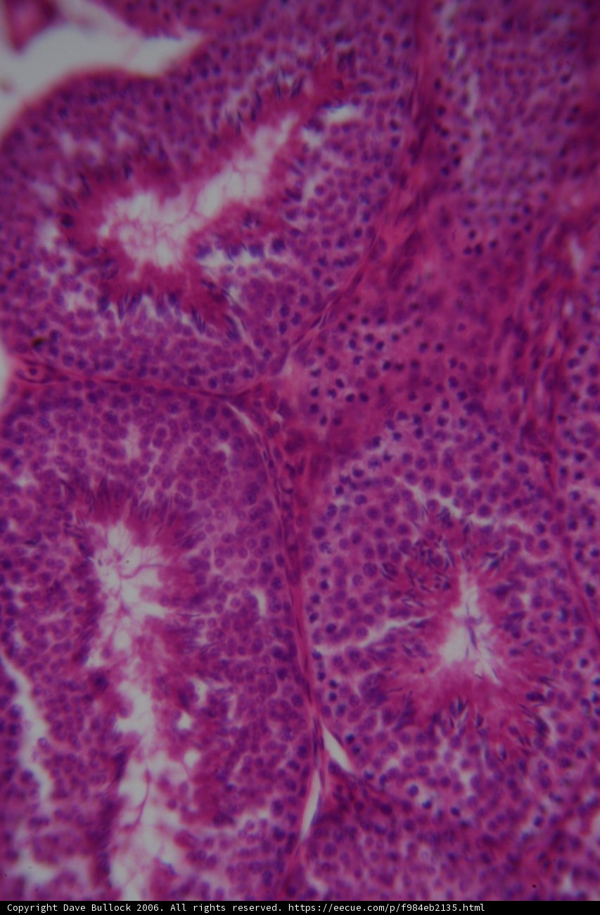 The Malignant Purple Mass
