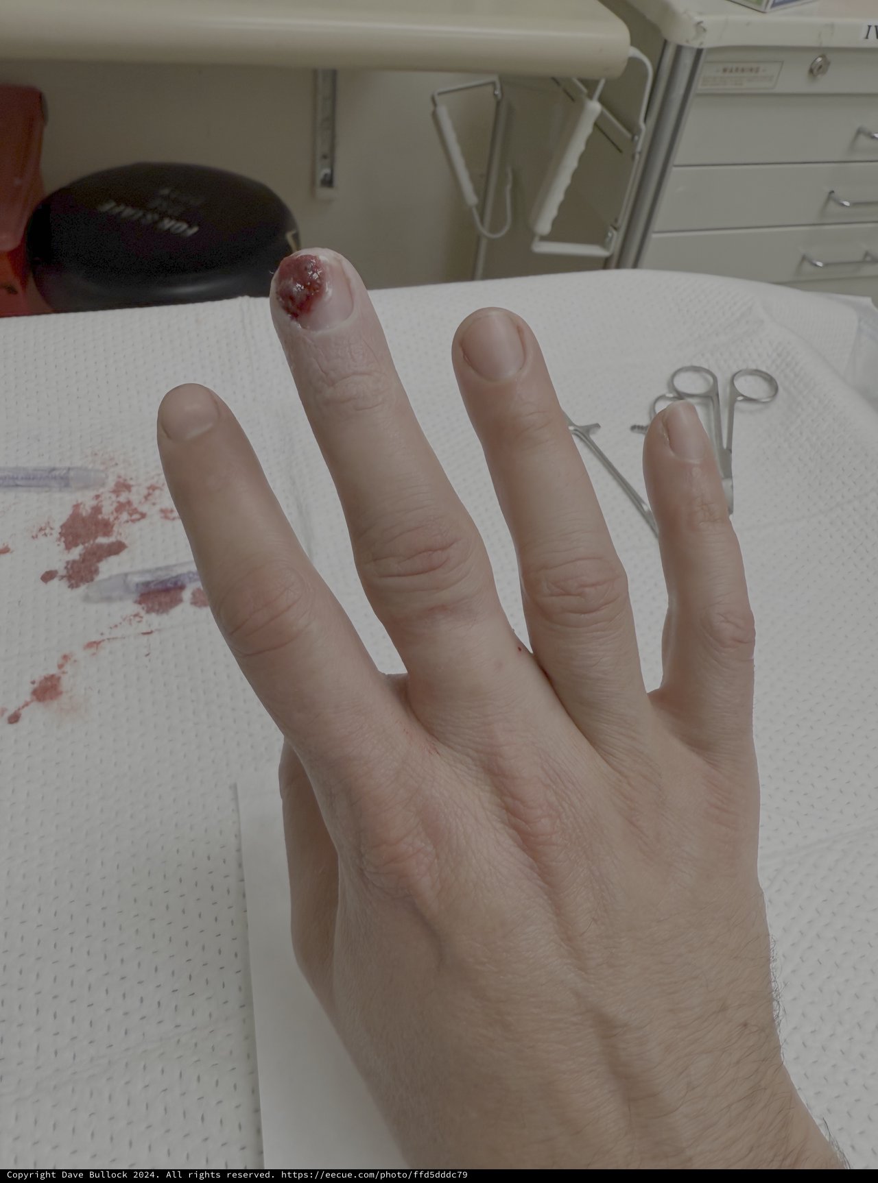 Injured Finger Receiving Medical Treatment