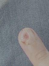 Close-up of Finger with Wart or Growth