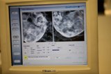 CT Scan of Woman's Chest