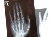 A broken hand, revealed by X-ray