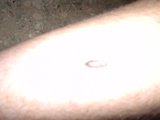 Bug on Man's Arm