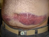 Bruised and Tattooed