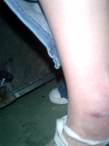Minor Injury