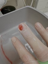 Injured Finger Being Cleaned in Sink