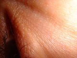 Mole on the Neck