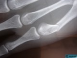 Fractured Bone in Close-Up
