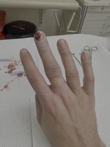 Injured Finger Receiving Medical Treatment