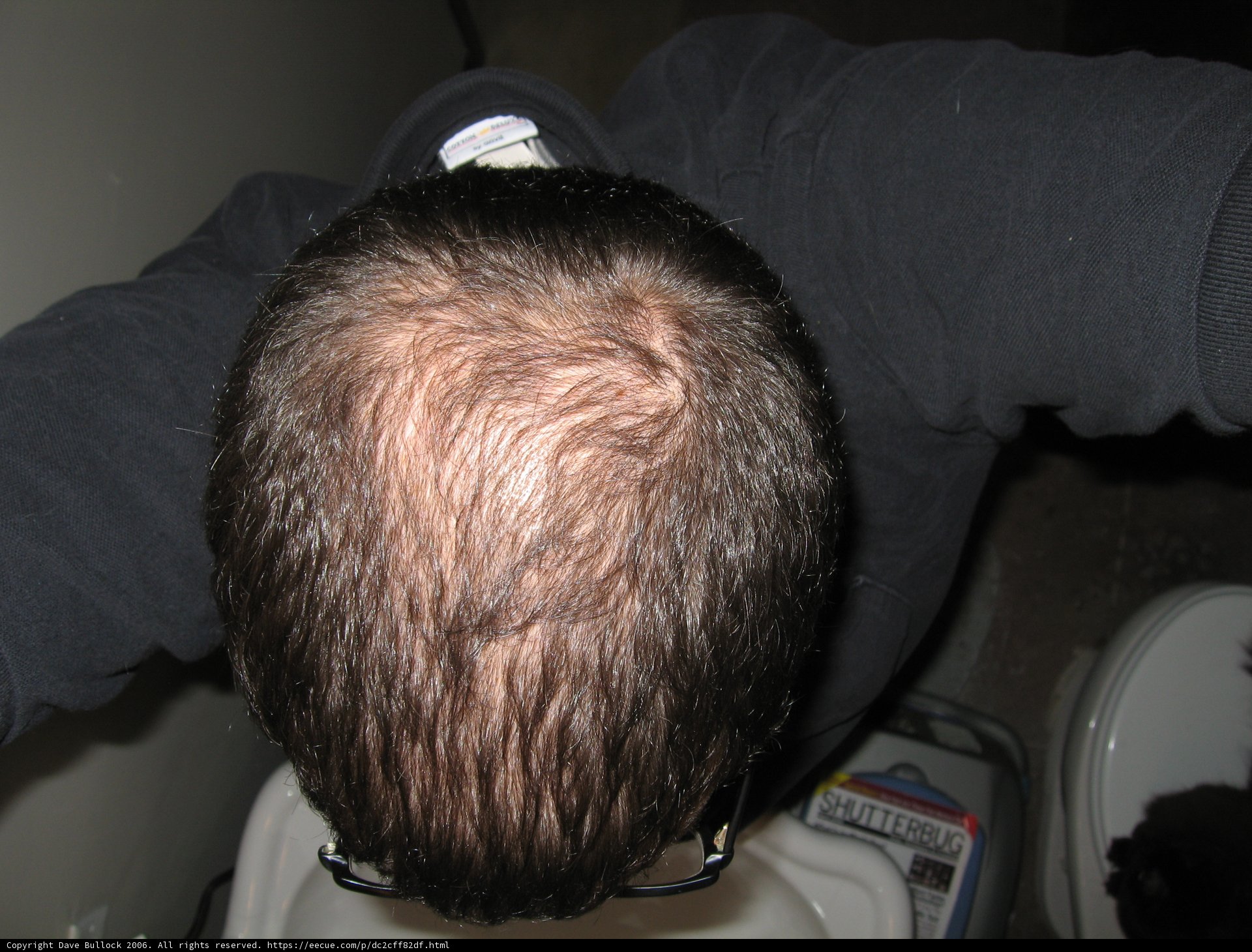 Receding Hairline
