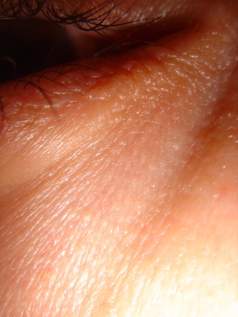 A Close-Up of a Person's Eye with a Large White Spot
