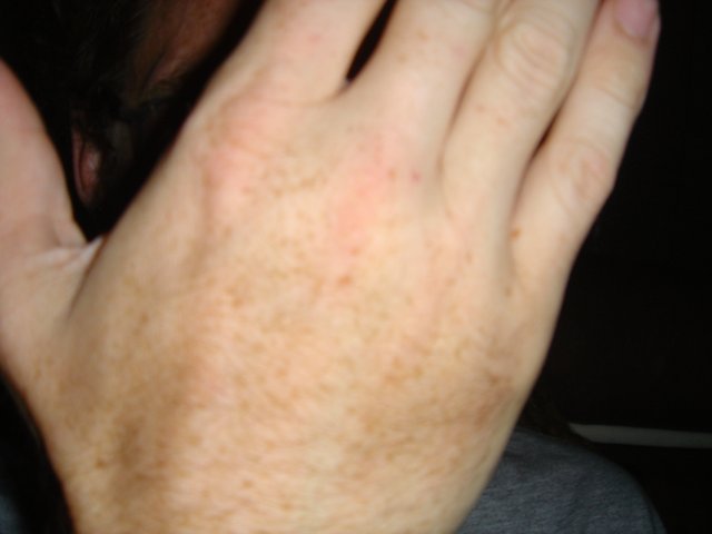 Freckled Fingers