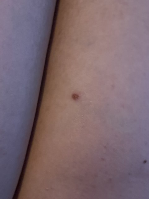 The Mole on My Arm