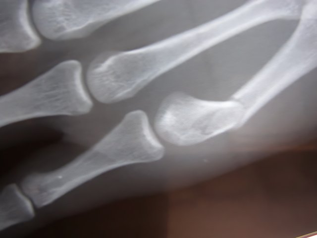 Broken Hand Bone