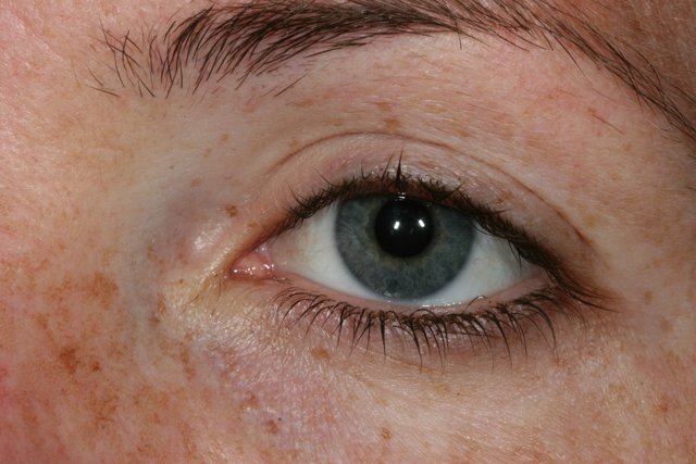 Freckled Eye