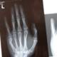 A broken hand, revealed by X-ray
