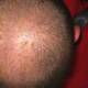 Yellow Patched Bald Head